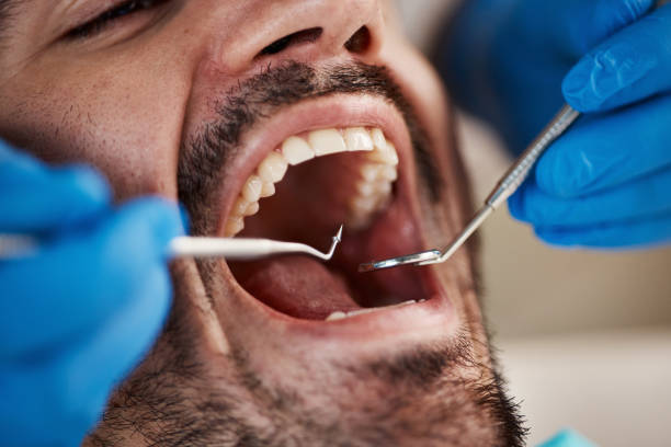 Best Emergency Dental Care for Broken or Chipped Teeth in South Hill, WA